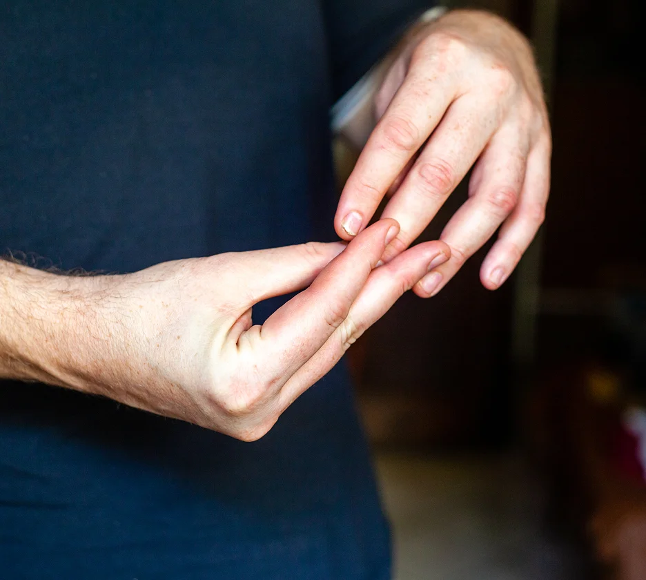 Tendones inflamados de los dedos de la mano por trabajo repetitivo