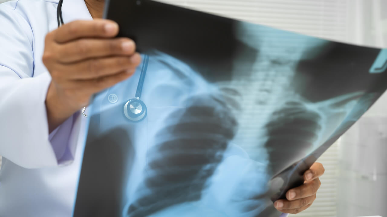 Fractura de costilla por accidente laboral en NY: síntomas, tratamiento y compensación